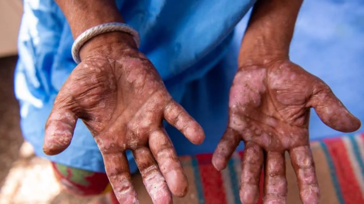 Caz de lepră confirmat la Cluj, alte trei sub evaluare